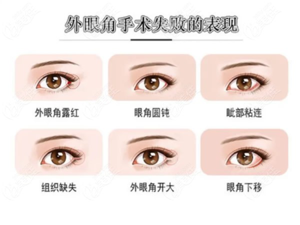 开外眼角手术失败症状图片