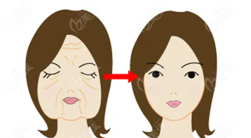 50歲做魔法超拉皮前后對比圖@美佳網(wǎng)