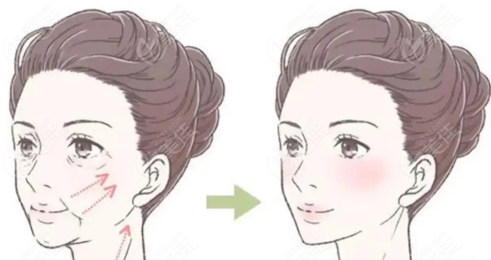 魔法超拉皮手術(shù)前后對比圖美佳網(wǎng)