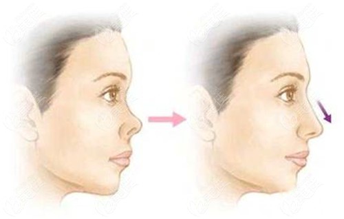 www.236z.com提供耳软骨鼻头挛缩修复成效对比