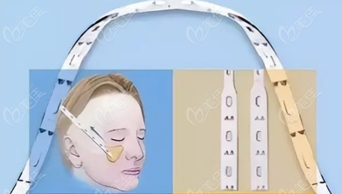 魔法超拉皮和微拉美的區(qū)別