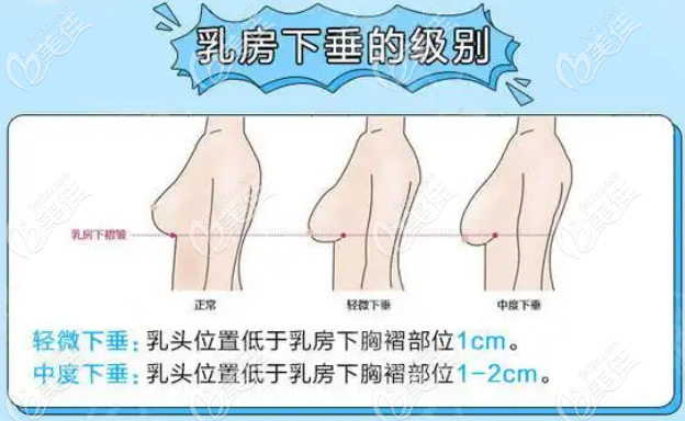 武汉艺星徐国建乳房下垂矫正类型