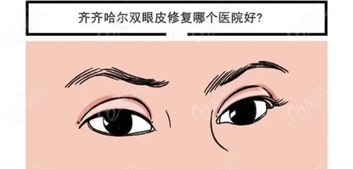 齊齊哈爾雙眼皮修復(fù)哪個(gè)醫(yī)院好