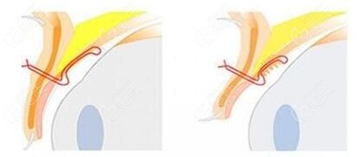 黑龍江瑞麗宋桂霞雙眼皮修復(fù)技術(shù)圖