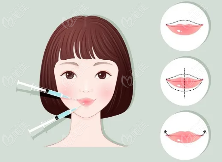 玻尿酸豐唇哪個(gè)牌子維持時(shí)間長(zhǎng)236z.com 玻尿酸豐唇哪個(gè)牌子維持時(shí)間長(zhǎng)236z.com