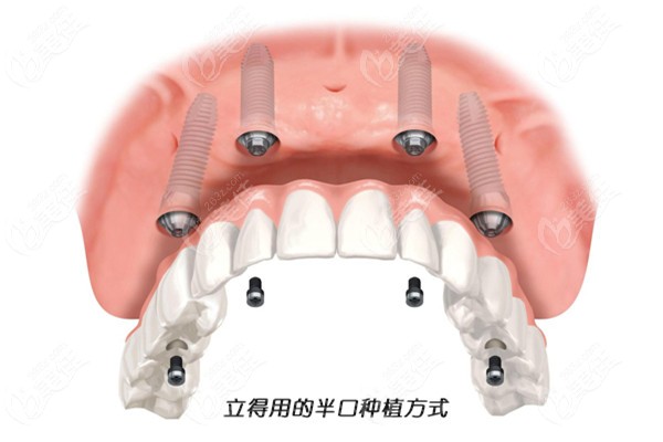 武汉中诺口腔医院立得用种植牙技术