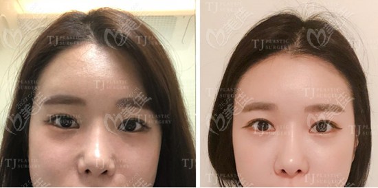 韩国TJ整形医院鼻翼缩小术前术后对比