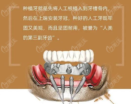 北京平谷种植牙补贴后多少钱