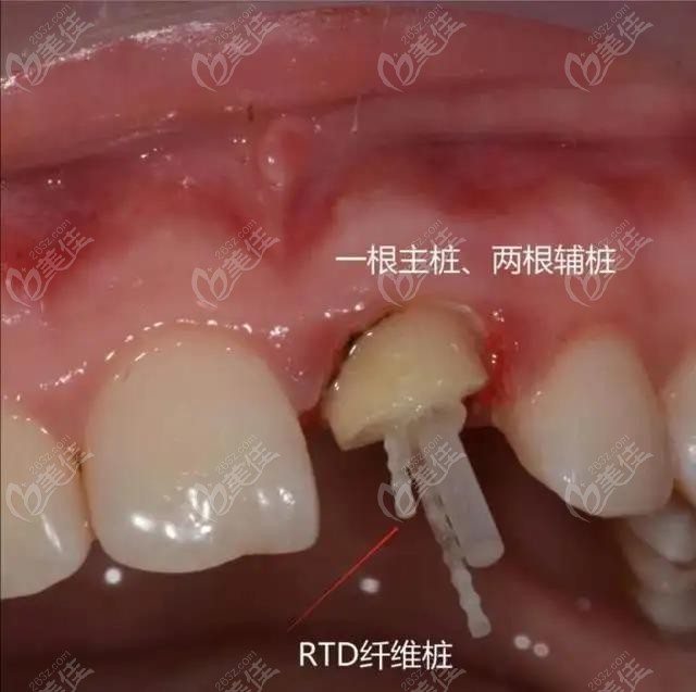 桩核冠打桩图片