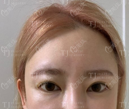 韩国面部拉皮手术哪家好？看韩国TJ整形医院做迷你拉皮真好有真人对比照为证