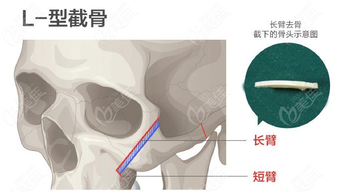 扬州做颧骨内推价格