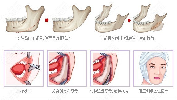 扬州做下颌角截骨价格www.236z.com