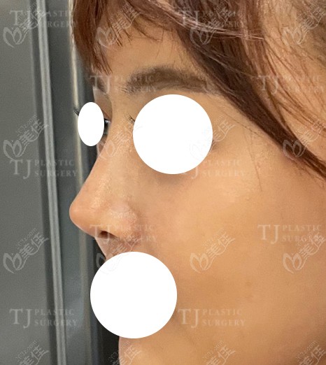 韩国TJ整形鼻综合术后的侧面照片