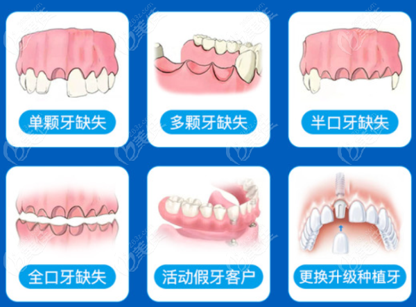 宜宾牙先生种牙技术怎么样