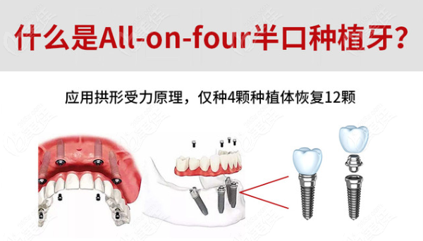 宜宾众植博仕口腔种牙好吗236z.com