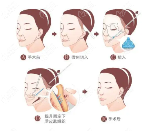 上海伊莱美脸部小切口拉皮手术过程