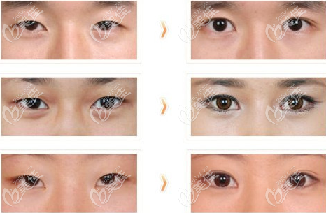 成鎮(zhèn)模院長自然風眼修復實例