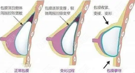 假体隆胸后胸变硬的原因m236z.com