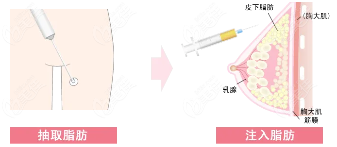 天水韩美脂肪丰胸手术