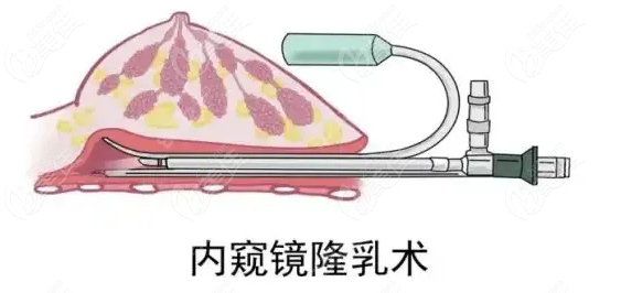 天水做内窥镜隆胸手术www.236z.com