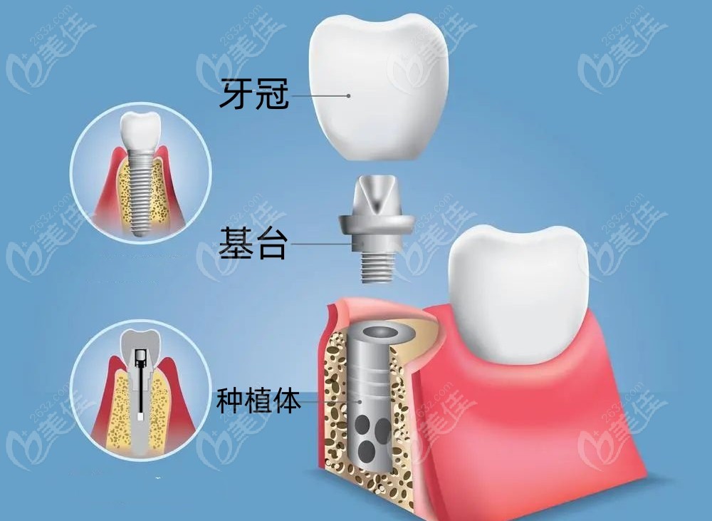 种植牙的结构示意图236z.com
