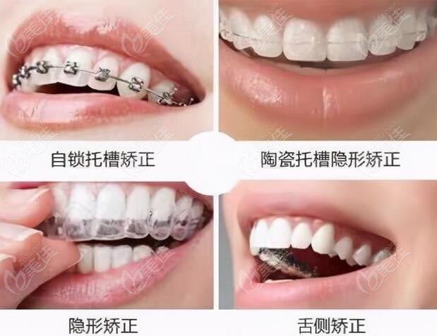 北京平谷区牙齿矫正价格表236z.com