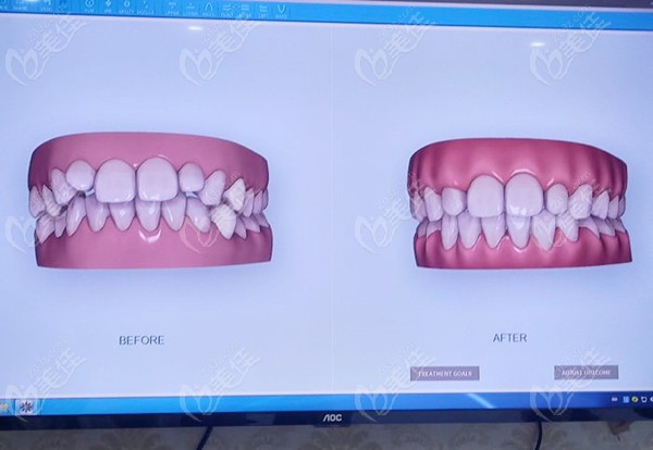 牙齿矫正前后对比模拟236z.com