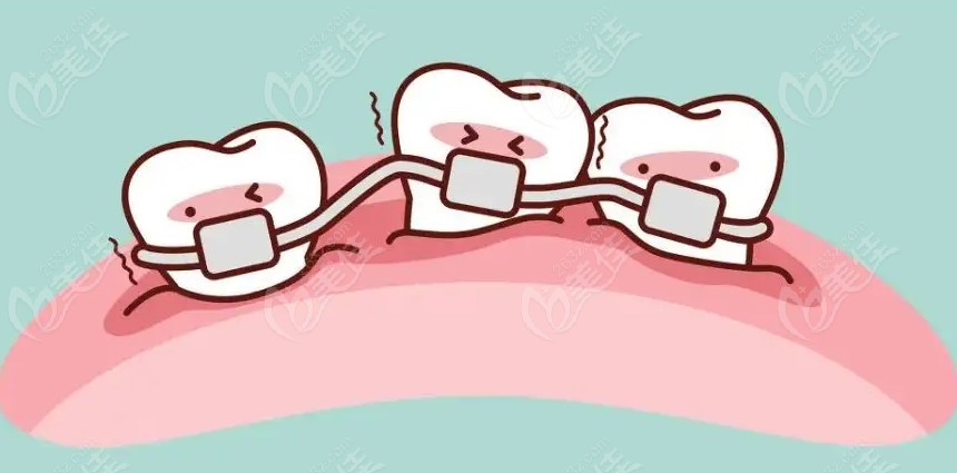 临沧矫正牙齿大概多少钱？