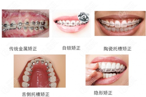 牙齿矫正器的类型图www.236z.com