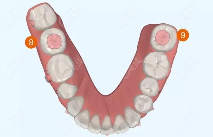 矫正牙齿颌垫起什么作用