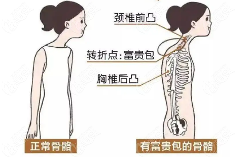 富贵包示意图