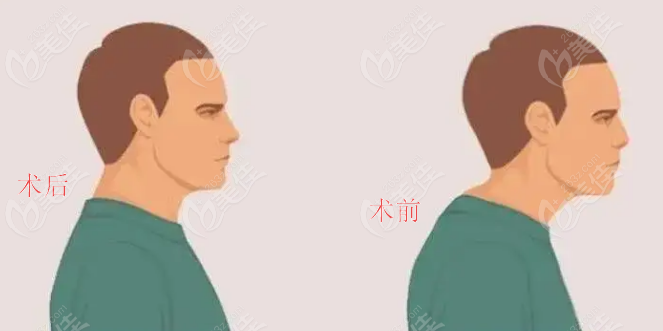 富贵包手术恢复图片二