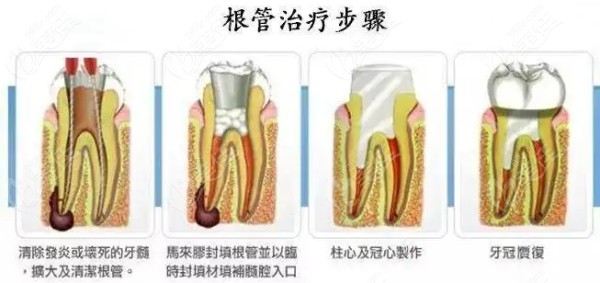 根管治疗流程图236z.com