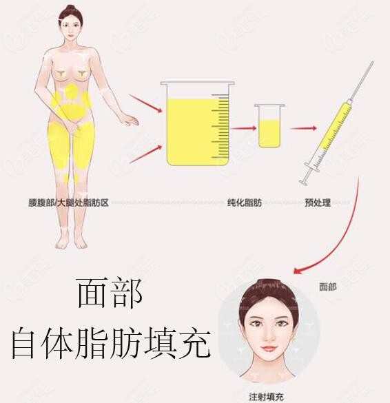 美佳网小编介绍北京简尔医疗美容许士海医生脂肪填充技术优势