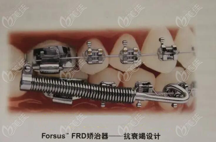 forsus活动矫正器图片