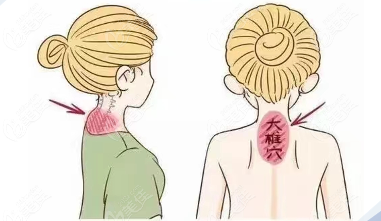 手术去富贵包部位