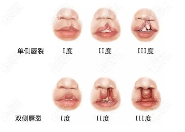 上海薇琳医院王国民医生唇腭裂修复费用大概多少钱