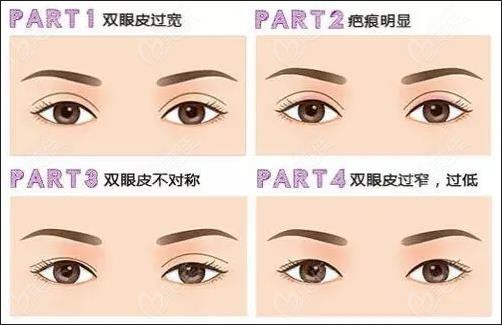 桂林双眼皮修复价格236z.com