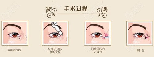 正常开眼角手术的原理图www.236z.com