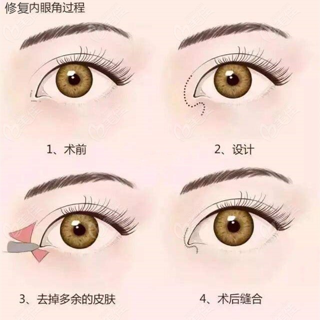 修复眼角括号型疤痕的原理图
