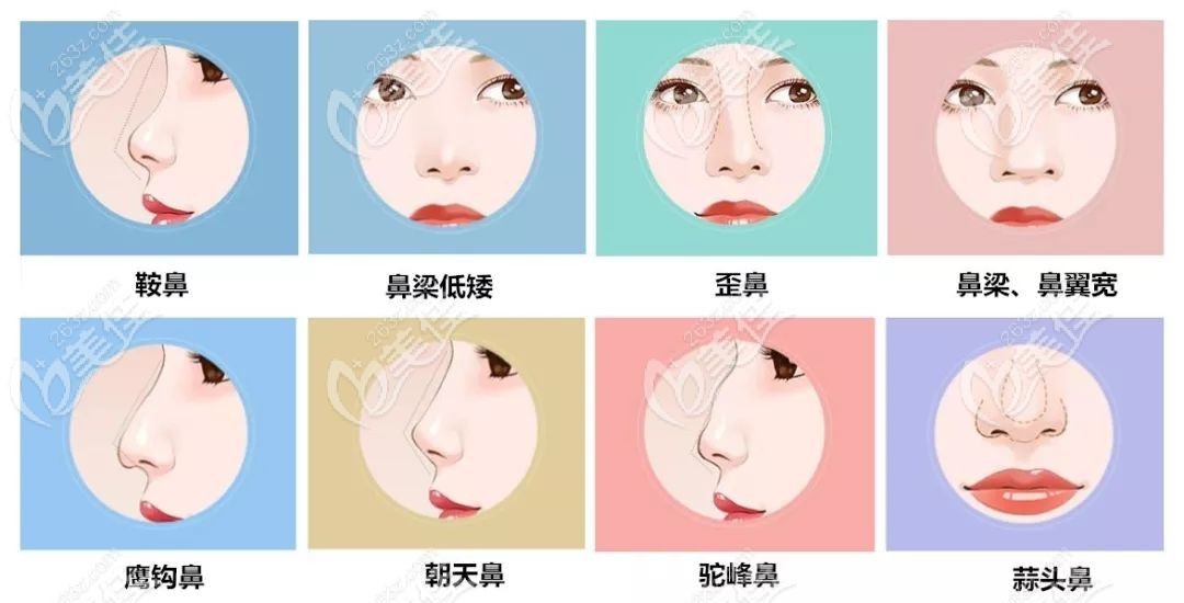 上海隆鼻手术医院可以改善鼻型