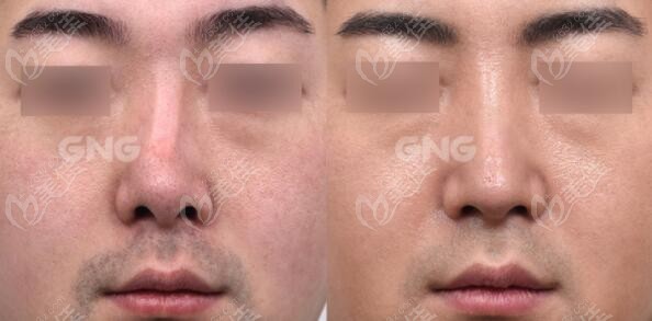 韩国GNG整形医院无假体隆鼻真人对比照