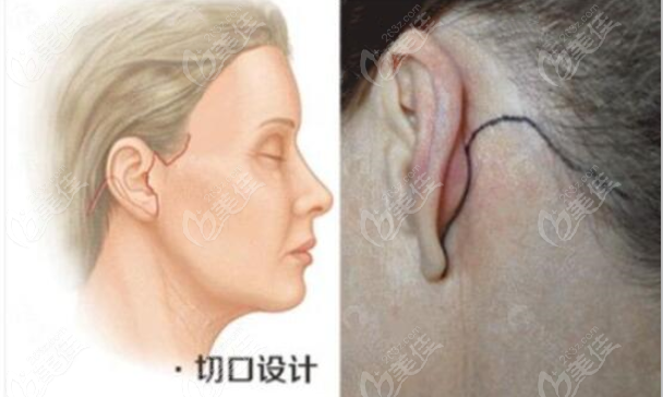 面部提升五层术的疗效挺不错的,它是在颞部和耳前耳后做切口,针对皮肤