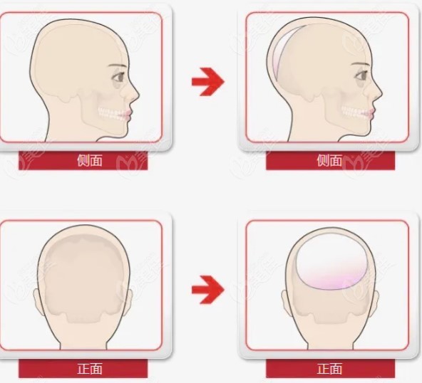 中国可以做后脑勺整形手术的医院名单m.236z.com