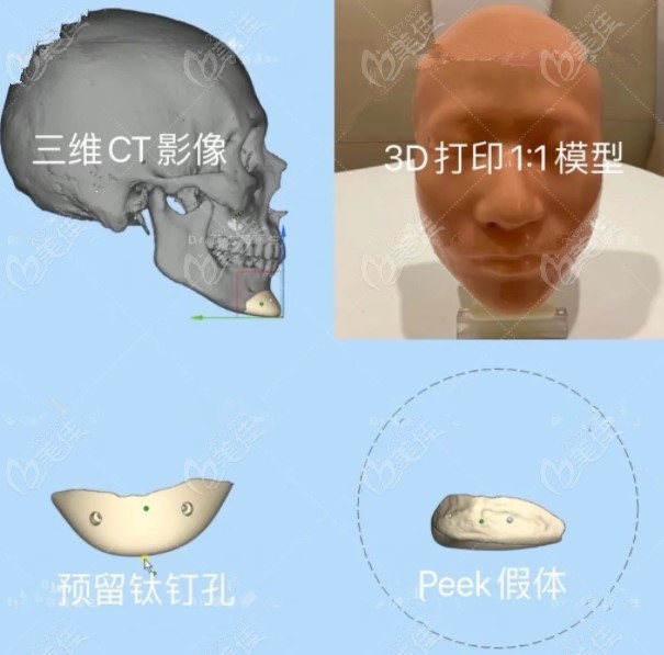 m.236z.com上海时光、西安国医和重庆宽仁医院做peek颅骨修复手术流程和操作