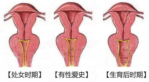 阴道紧缩有微创的手术