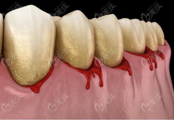 引起边缘性牙龈炎的原因