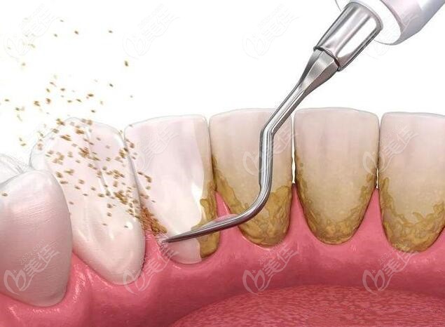 牙龈炎治疗方法之洗牙示意图