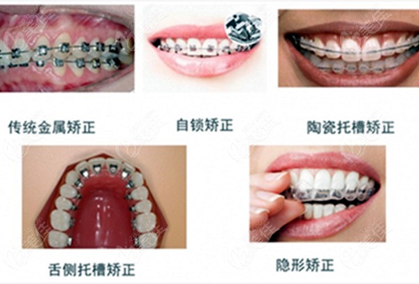 各类牙齿矫正器的图
