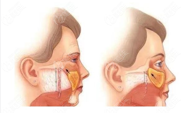 内窥镜拉皮手术对比传统拉皮手术哪个好236z.com